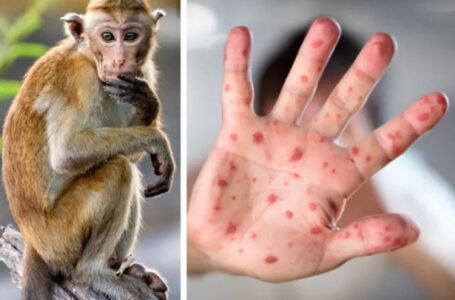 الوطني لمكافحة الأمراض يعلن خلو البلاد من مرض جدري القرود